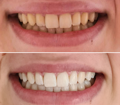 before-after1