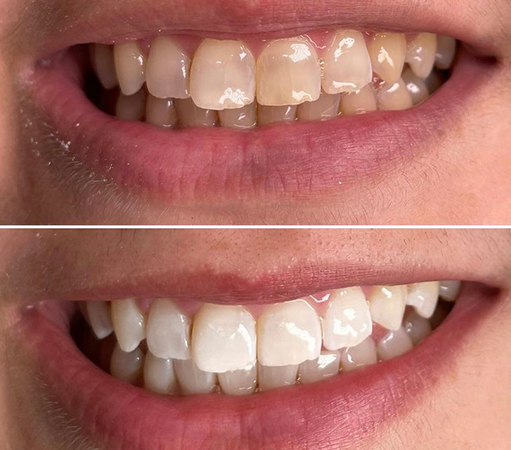 before-after4