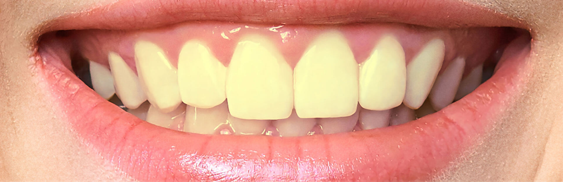 teeth-before