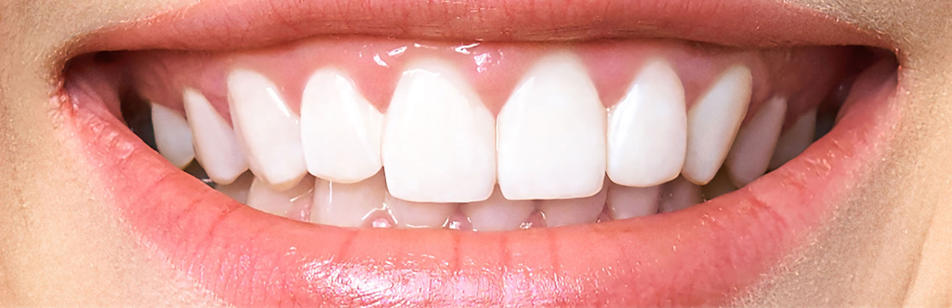teeth-after